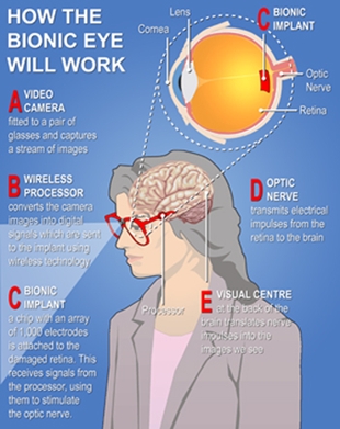Como funcionará o ollo biónico